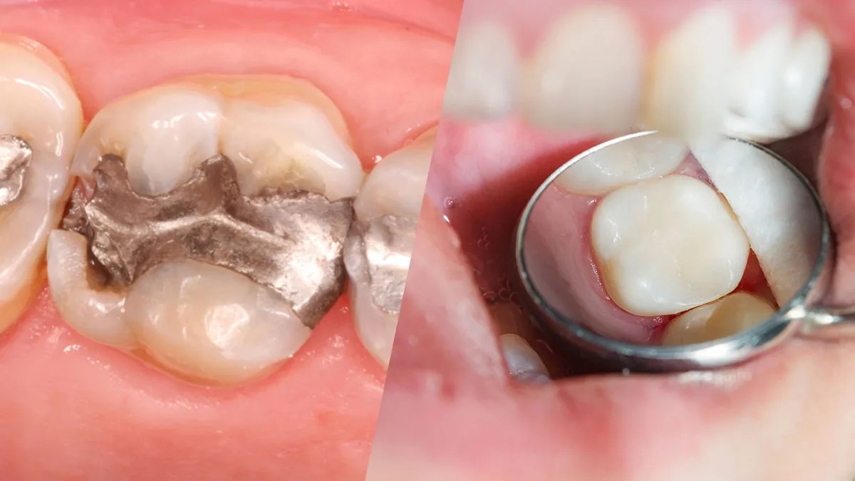 A Comprehensive Guide to White Fillings vs. Amalgam at Skymark Smile